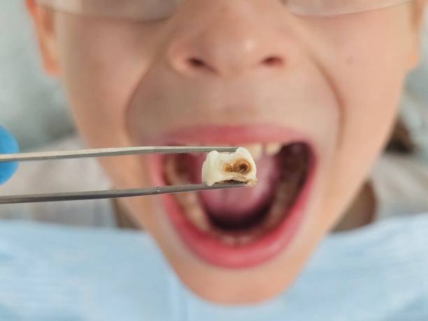 Best Emergency Treatment for Dental Infections or Abscesses in Inglewood, CA